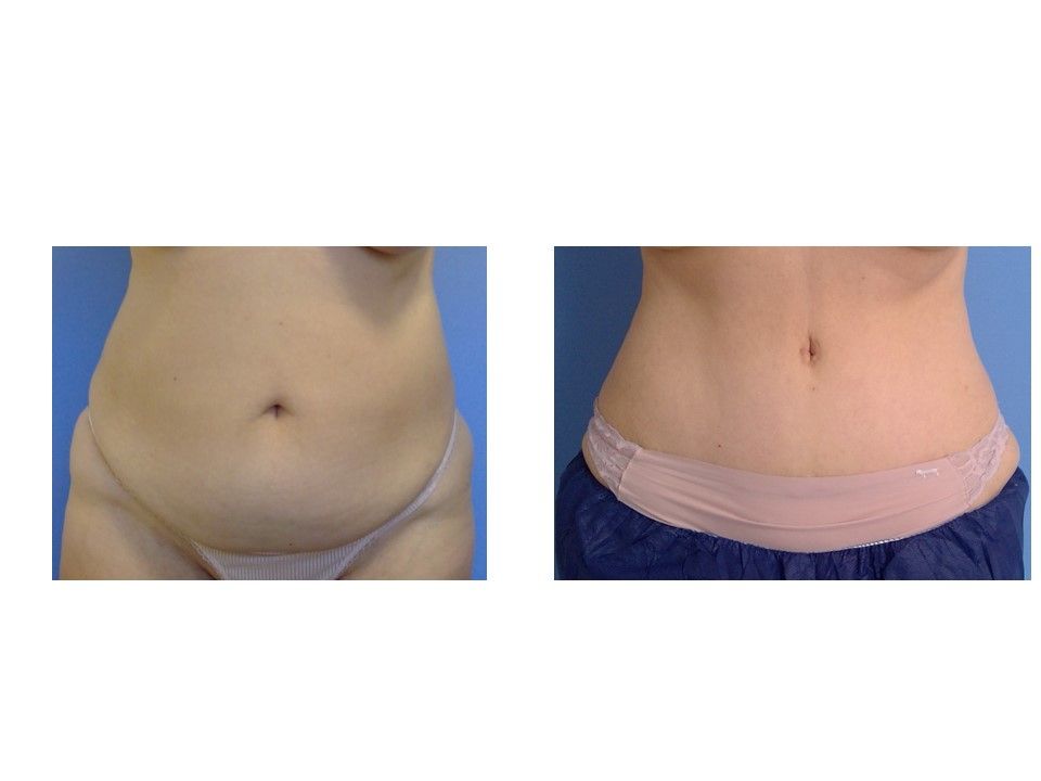 A before and after picture of a woman 's stomach.