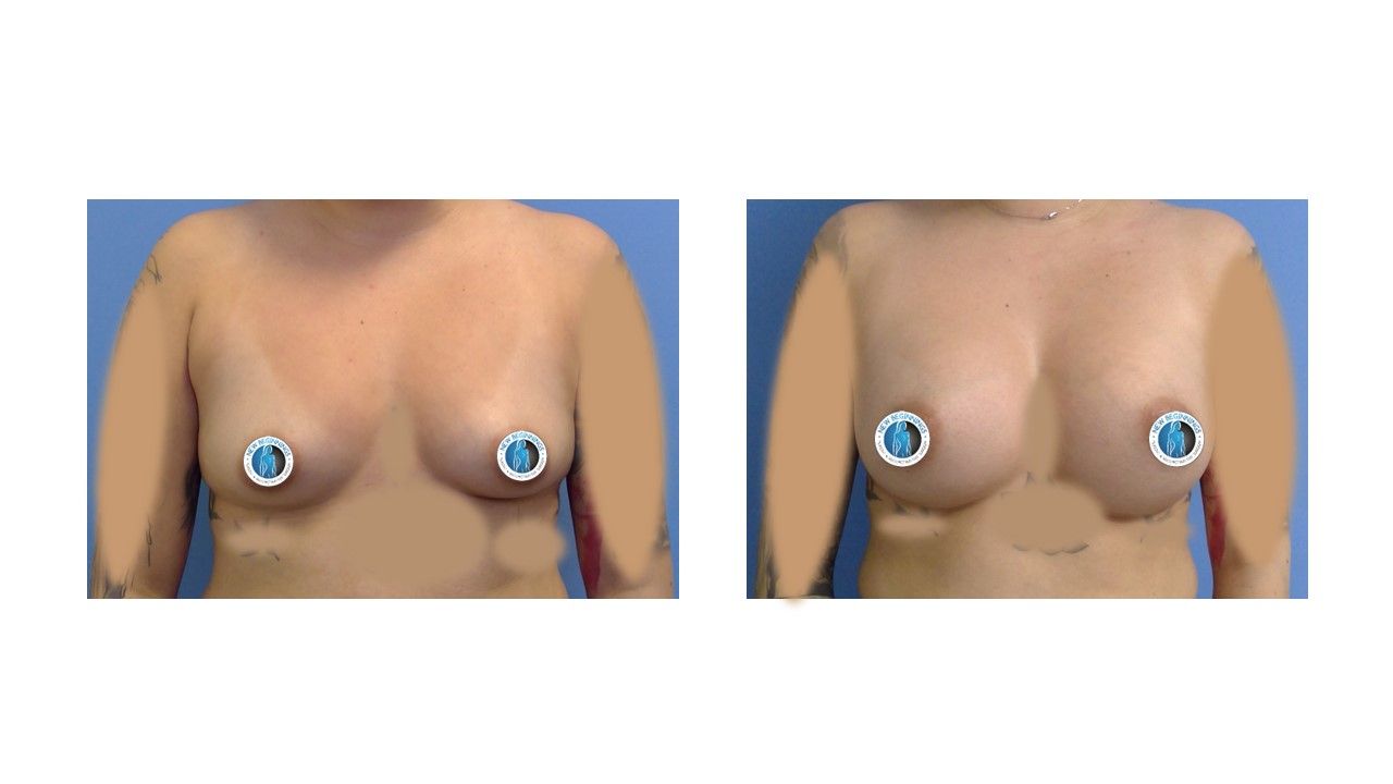 Breast Augmentation