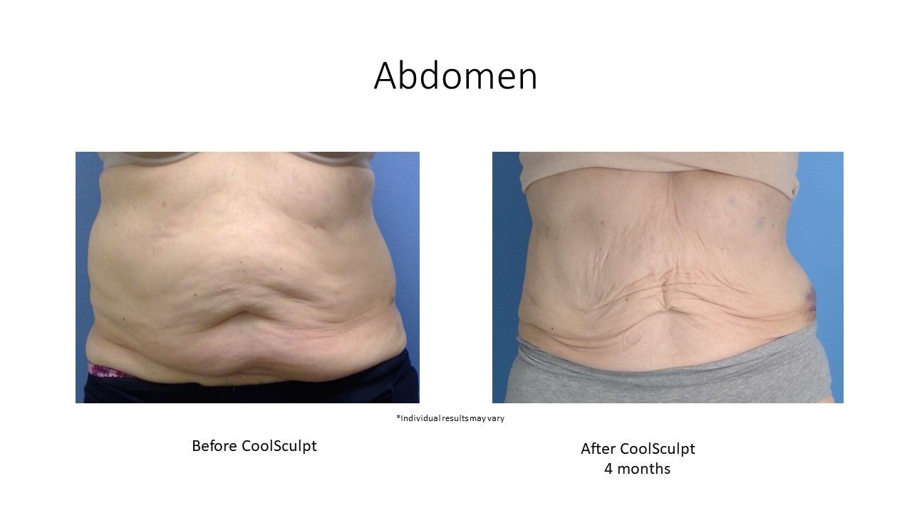 Two pictures of a woman 's abdomen before and after surgery