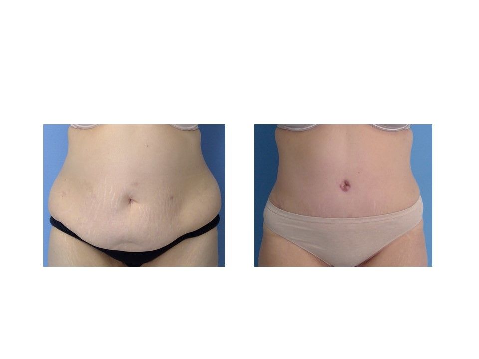 A before and after picture of a woman 's stomach.