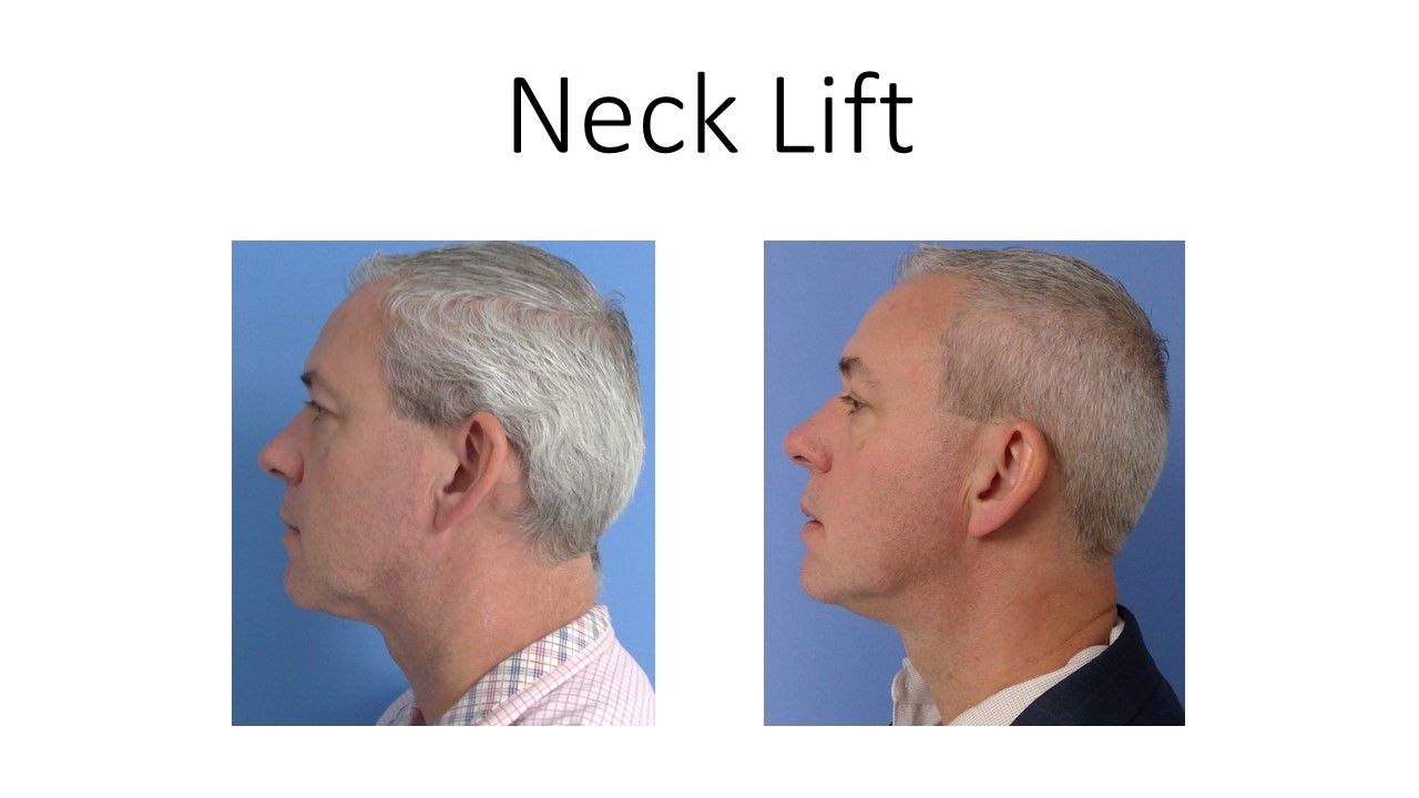 Neck Lift Before and After