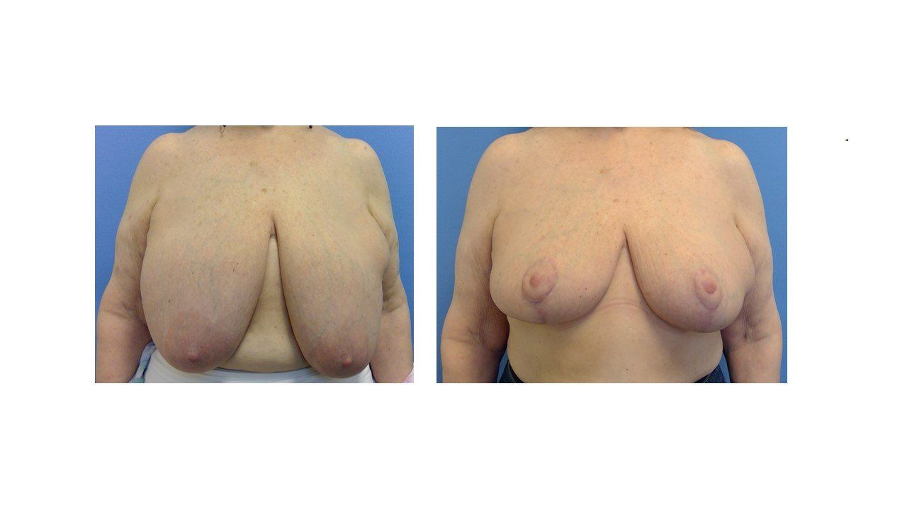 Breast Reduction - before after