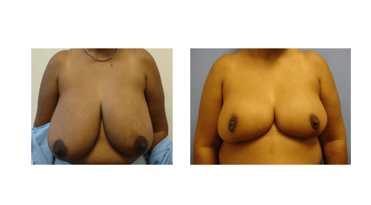 Before/After - Breast Reduction