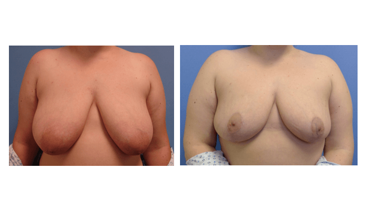 Before/After - Breast Reduction