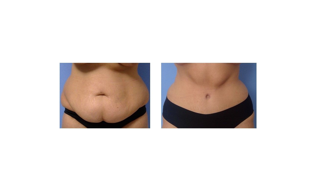 A woman 's stomach is shown before and after surgery.