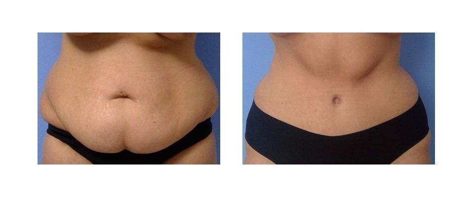 A woman's stomach is shown before and after surgery.