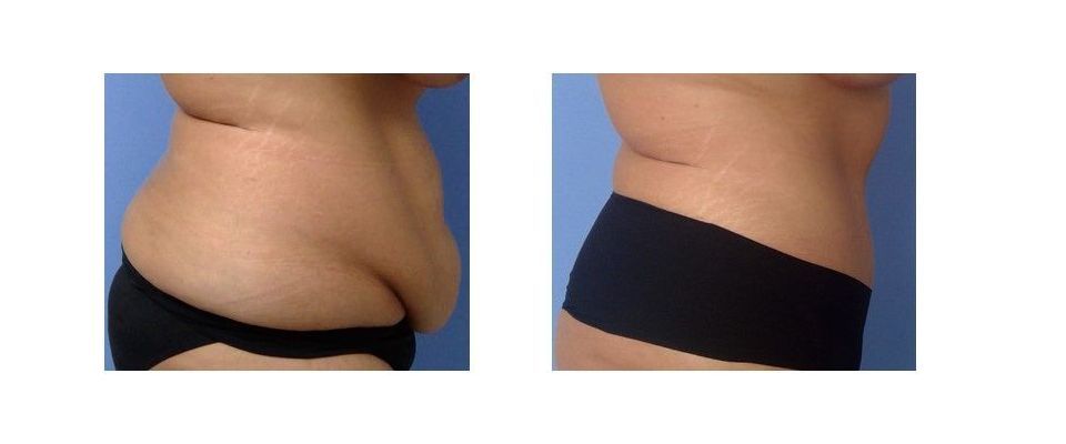 A before and after picture of a woman's stomach.