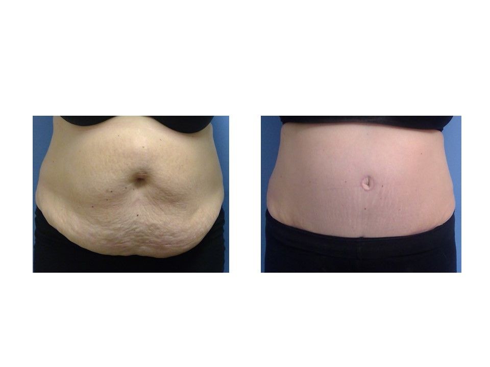 A before and after picture of a woman 's stomach.