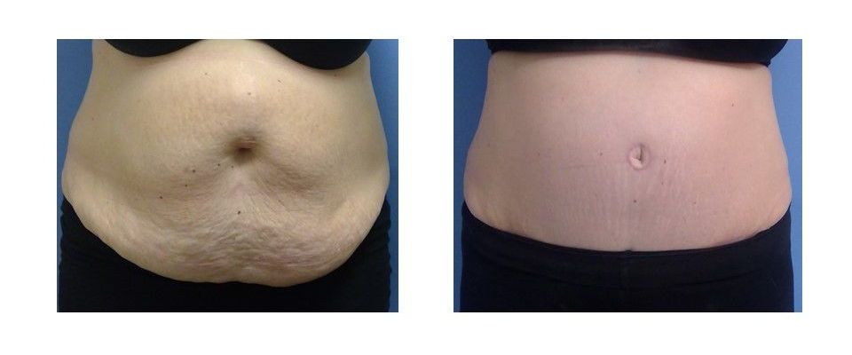 A before and after picture of a woma 's stomach.