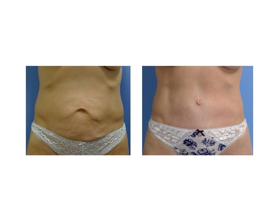 A before and after picture of a woman 's stomach.