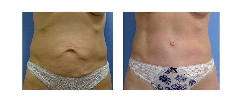 A before and after picture of a woman's stomach.
