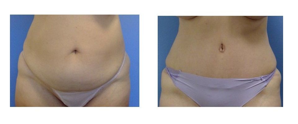 A before and after picture of a woman's stomach.
