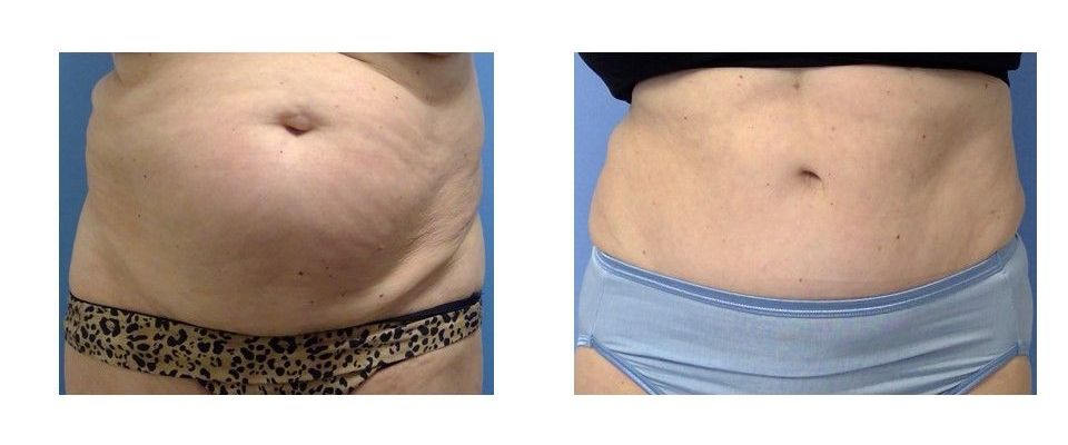 A before and after picture of a woman's stomach.