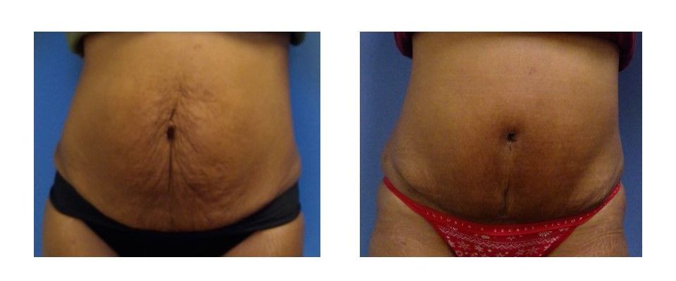 A before and after picture of a woman's stomach