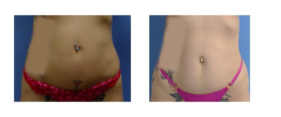 A before and after picture of a woman's stomach in a bikini.