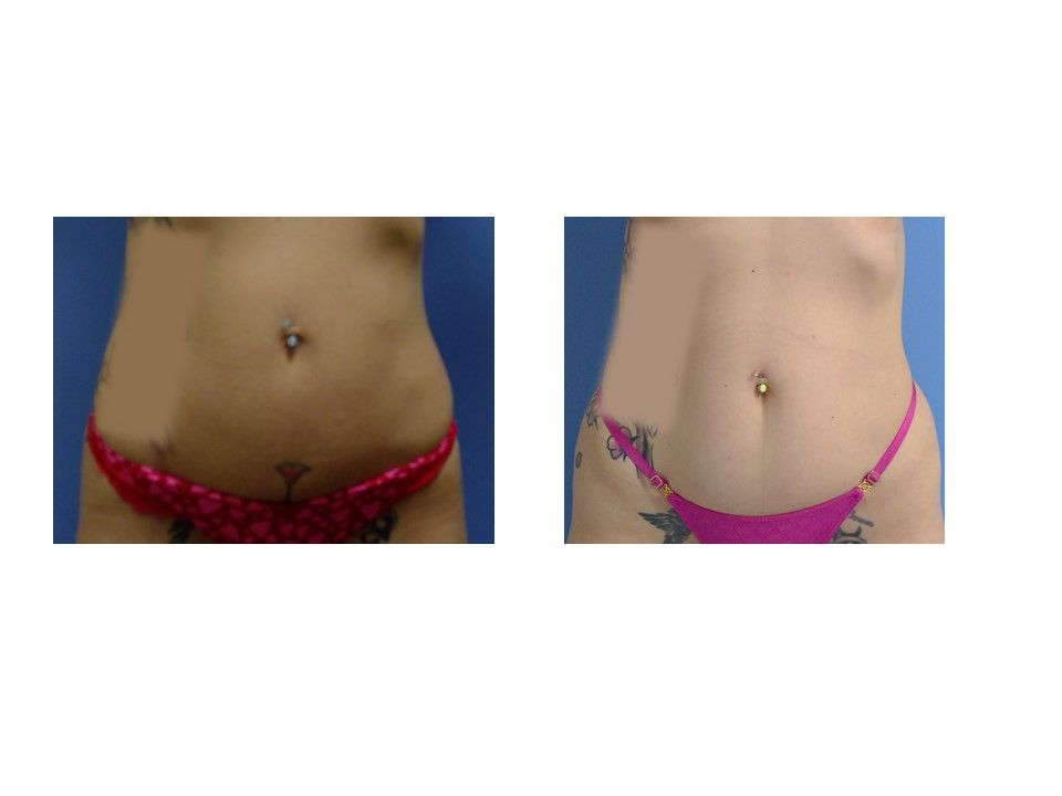 A before and after picture of a woman 's stomach in a bikini.