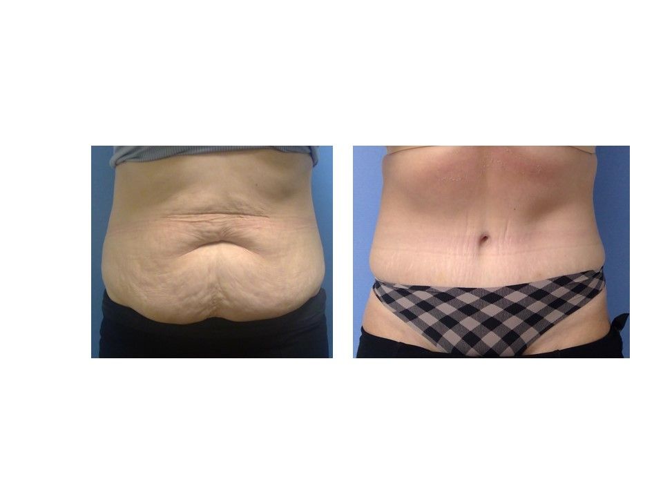 A before and after picture of a woman 's stomach in plaid underwear.