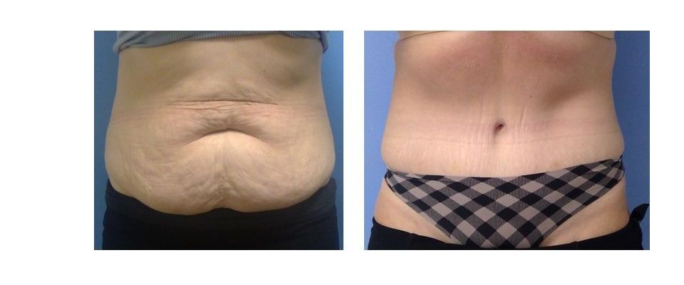 A before and after picture of a woman's stomach in plaid underwear.