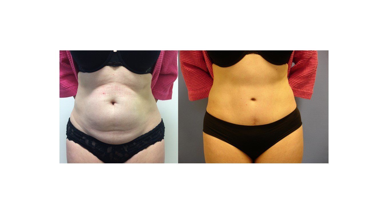 A before and after picture of a woman 's stomach.