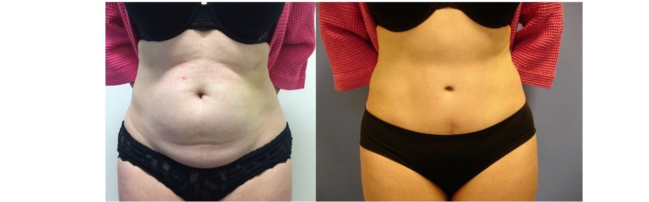 A before and after picture of a woman 's stomach.