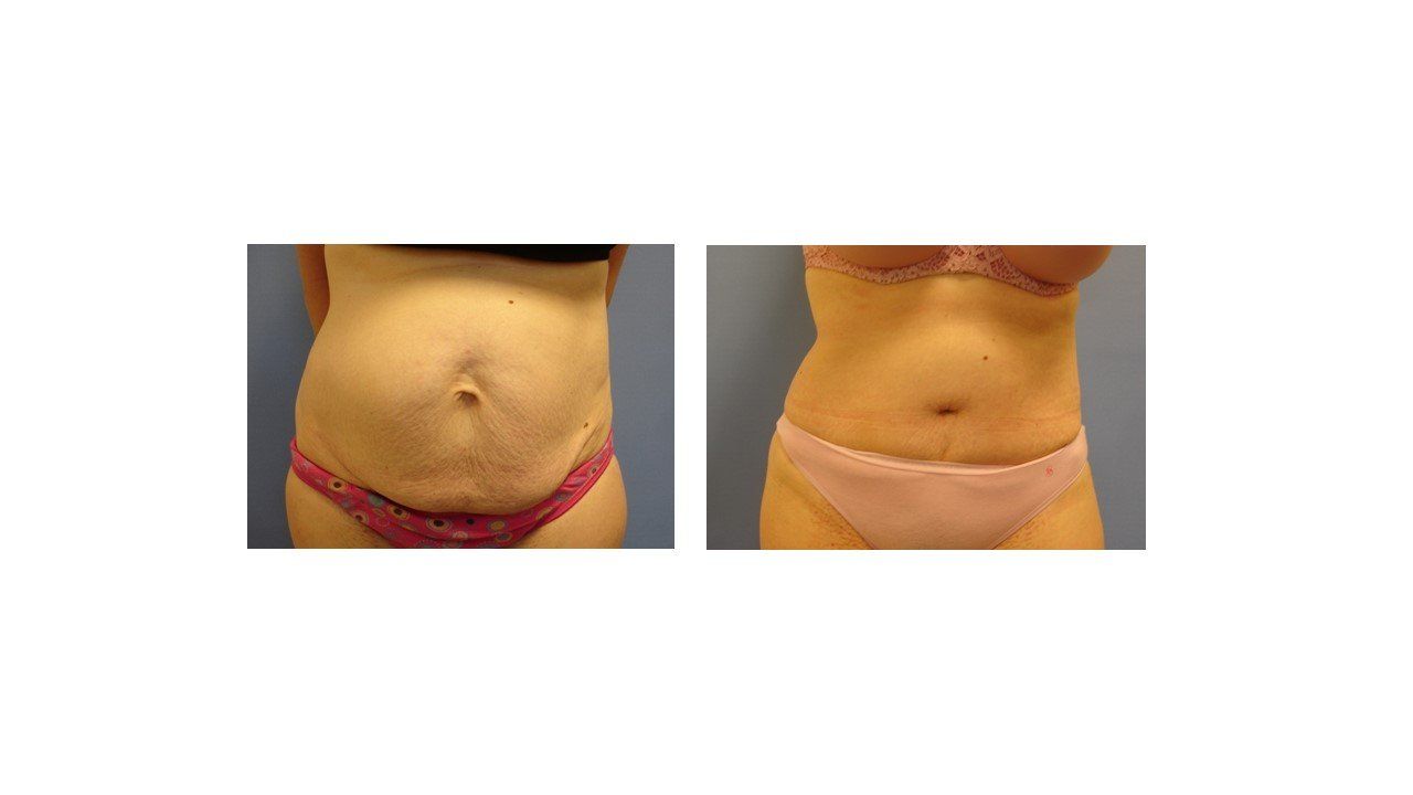 A before and after picture of a woman 's stomach.