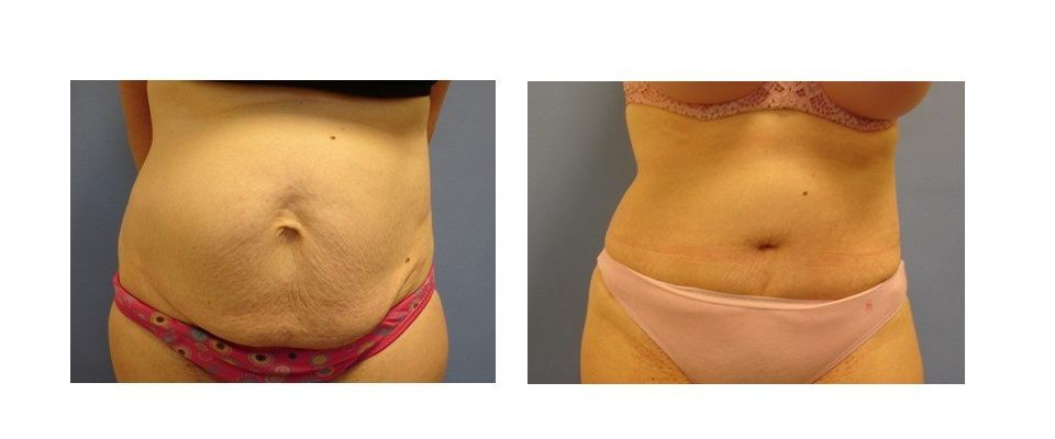 A before and after picture of a woman 's stomach.