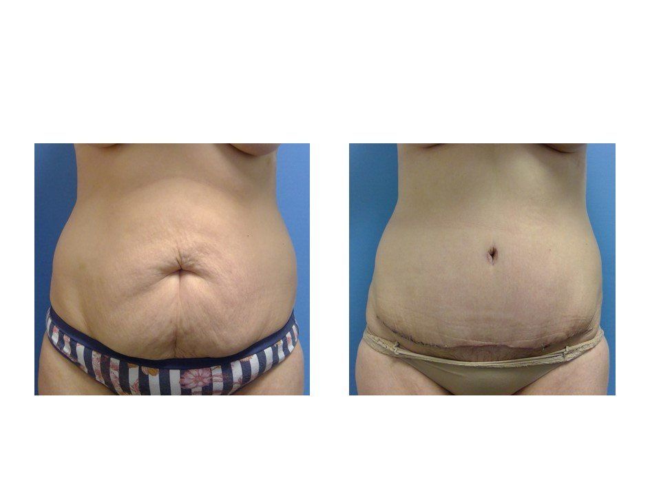 A woman 's stomach is shown before and after surgery.