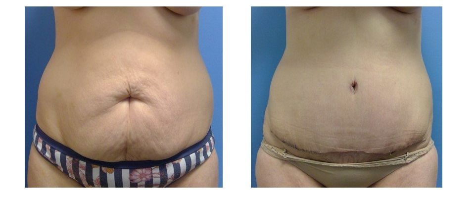 A woman 's stomach is shown before and after surgery.