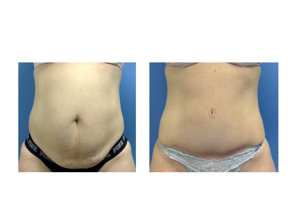 A before and after picture of a woman 's stomach.