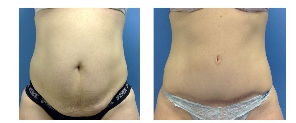 A before and after picture of a woman 's stomach.
