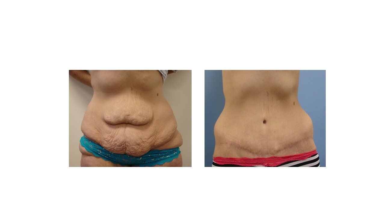 A before and after picture of a woman 's stomach.