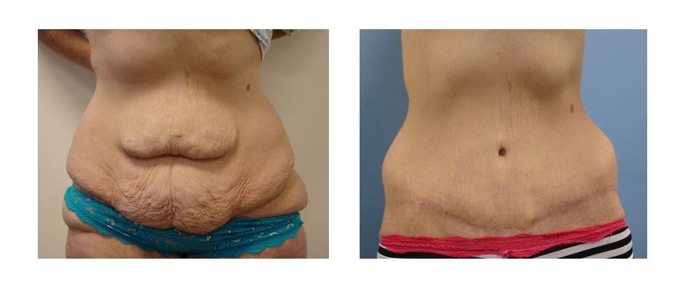 A before and after picture of a woman 's stomach.