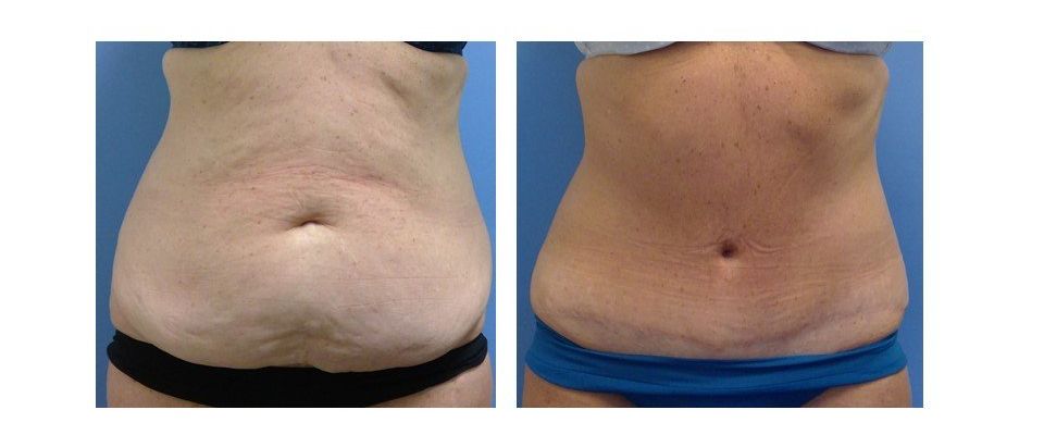 A before and after picture of a woman 's stomach.