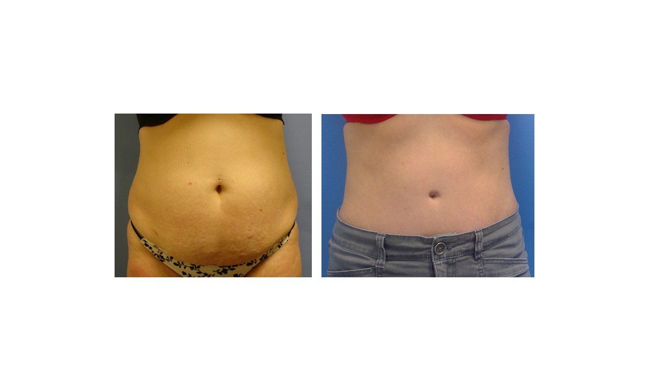 A before and after picture of a woman 's stomach.