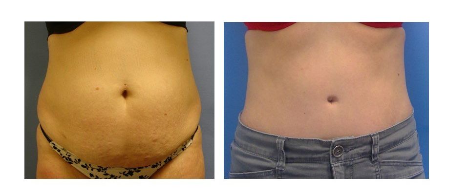 A before and after picture of a woman 's stomach.