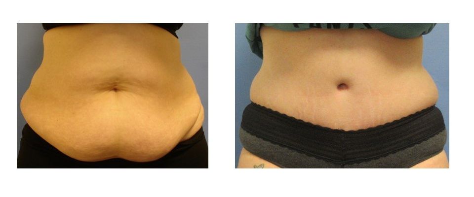 A before and after picture of a woman 's stomach.