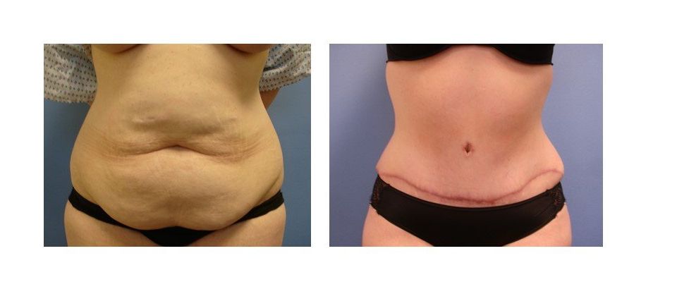 A woman 's stomach before and after surgery.