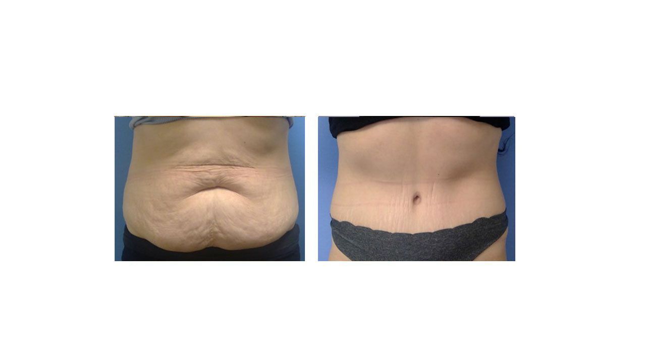 A before and after picture of a woman 's stomach.