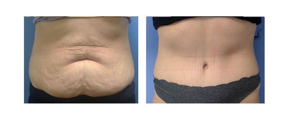 A before and after picture of a woman 's stomach.