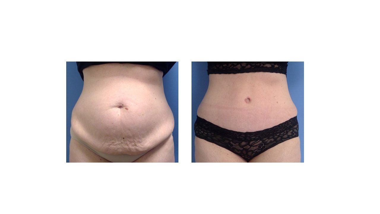 A before and after picture of a woman 's stomach