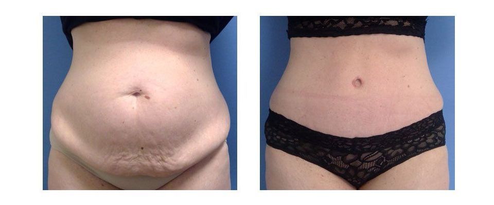 A before and after picture of a woman 's stomach