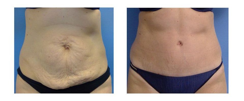 A before and after picture of a woman 's stomach.