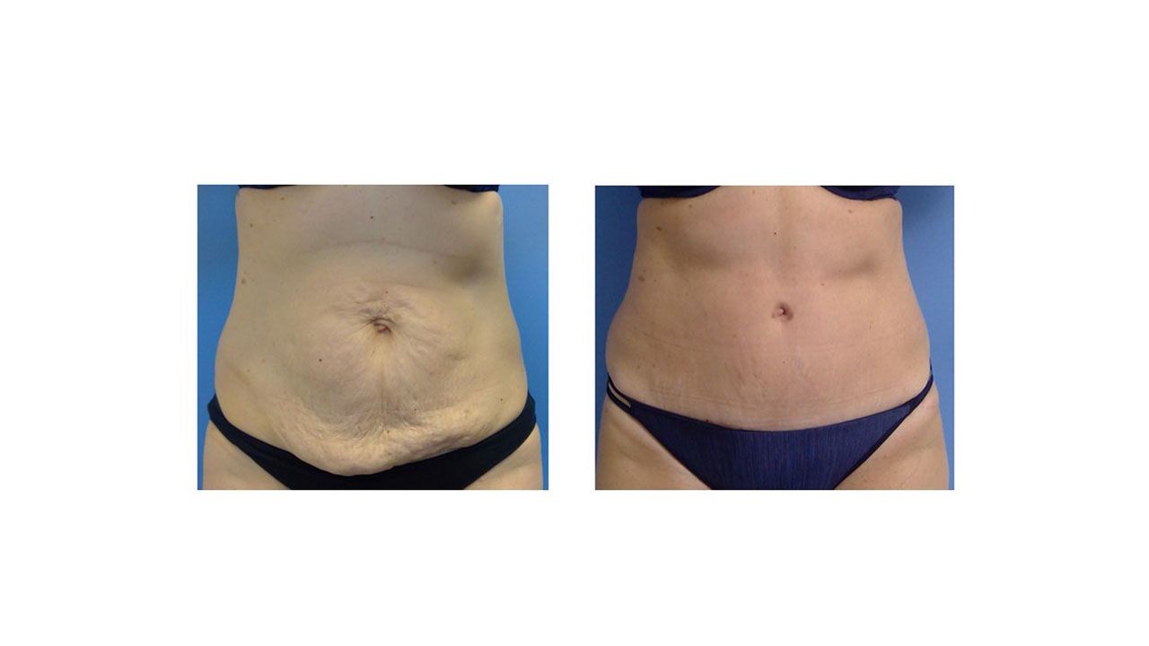 A before and after picture of a woman 's stomach.