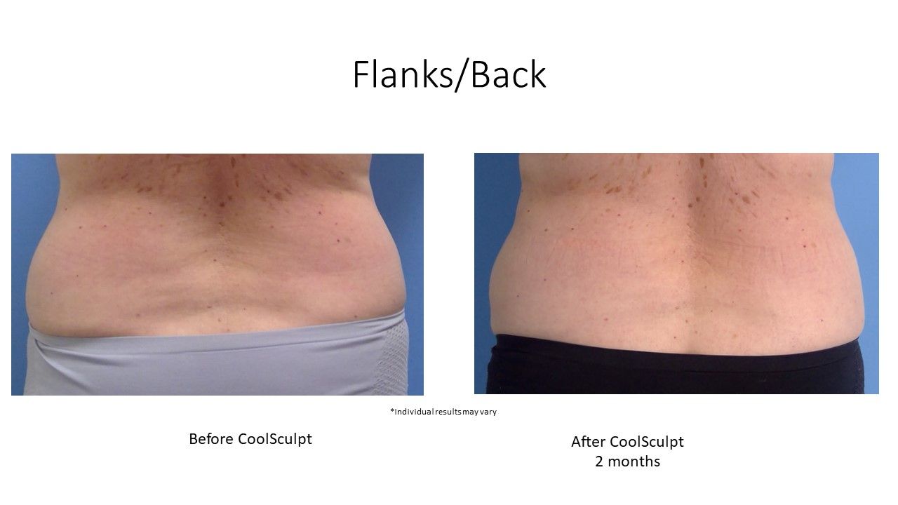 before and after CoolSculpting flanks and back