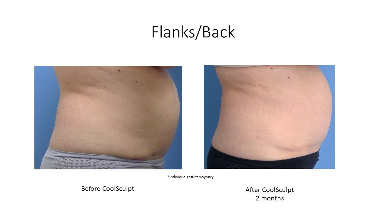 before and after CoolSculpting flanks and side