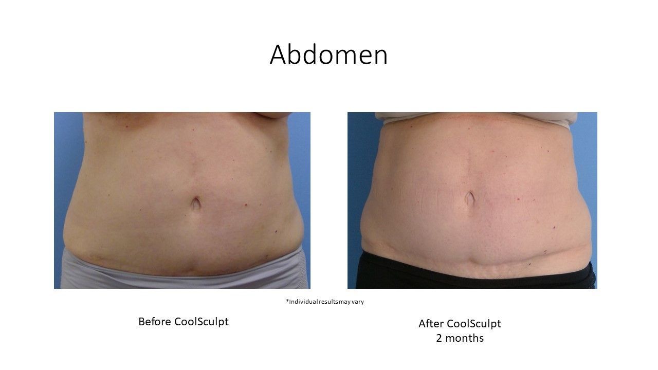 before and after CoolSculpting abdomen