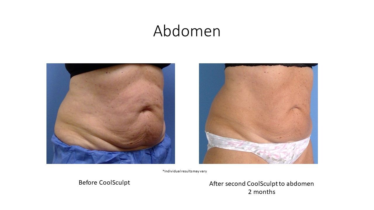 before and after images abdomen