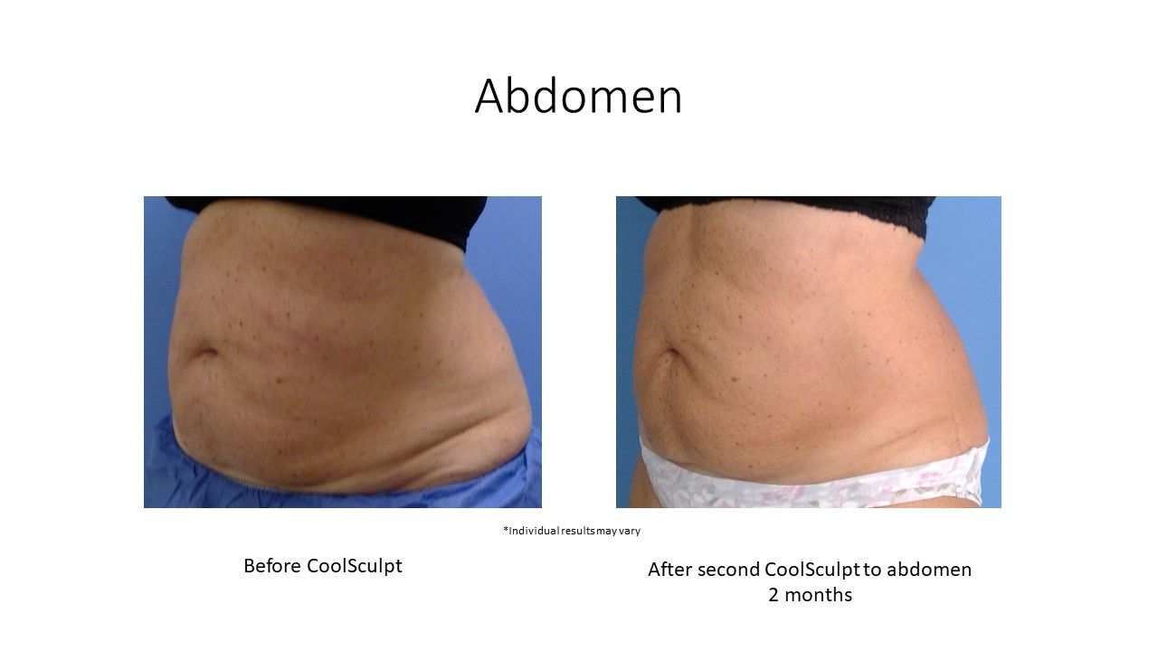 before and after images abdomen front and side view
