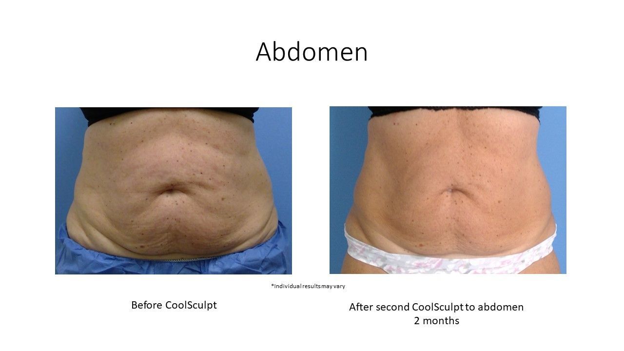 before and after images abdomen front view