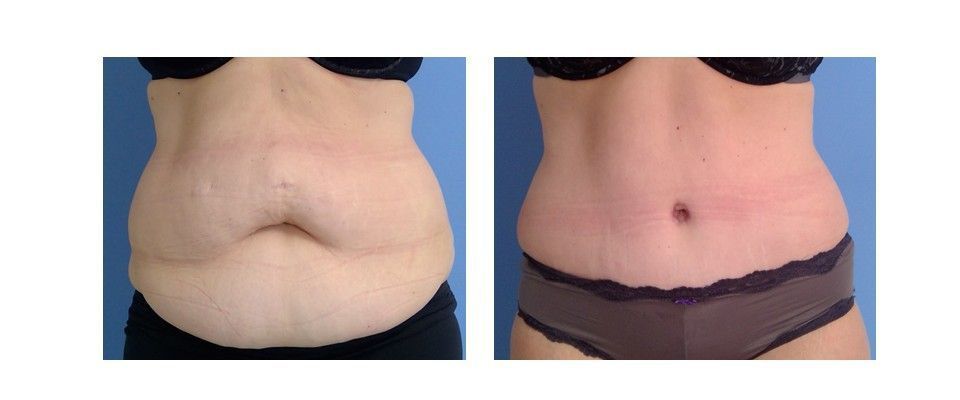 A woman's stomach before and after surgery.